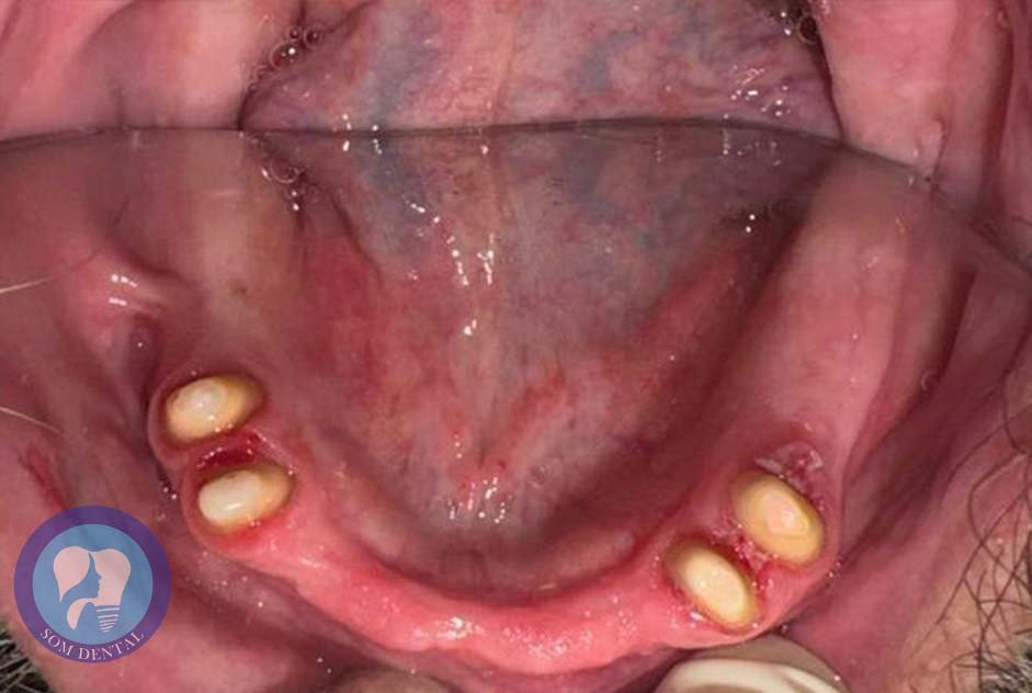 Cast Partial Dentures Gallery 2