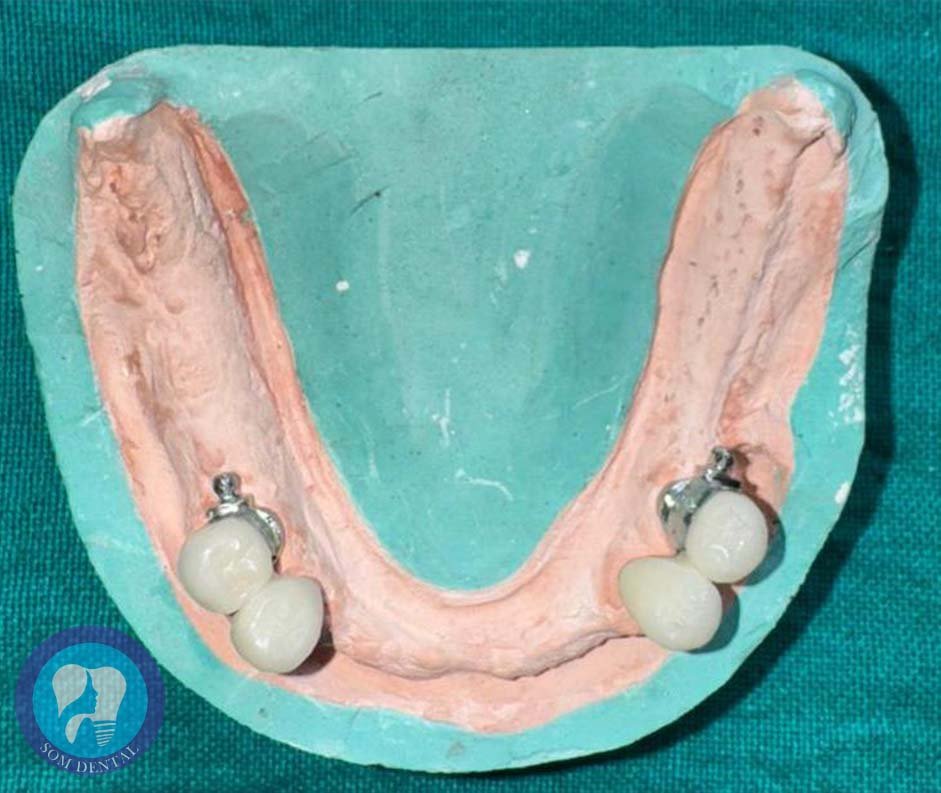 Cast Partial Dentures Gallery 3