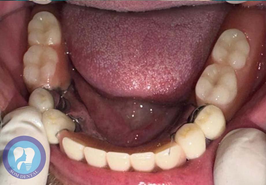 Cast Partial Dentures Gallery 5