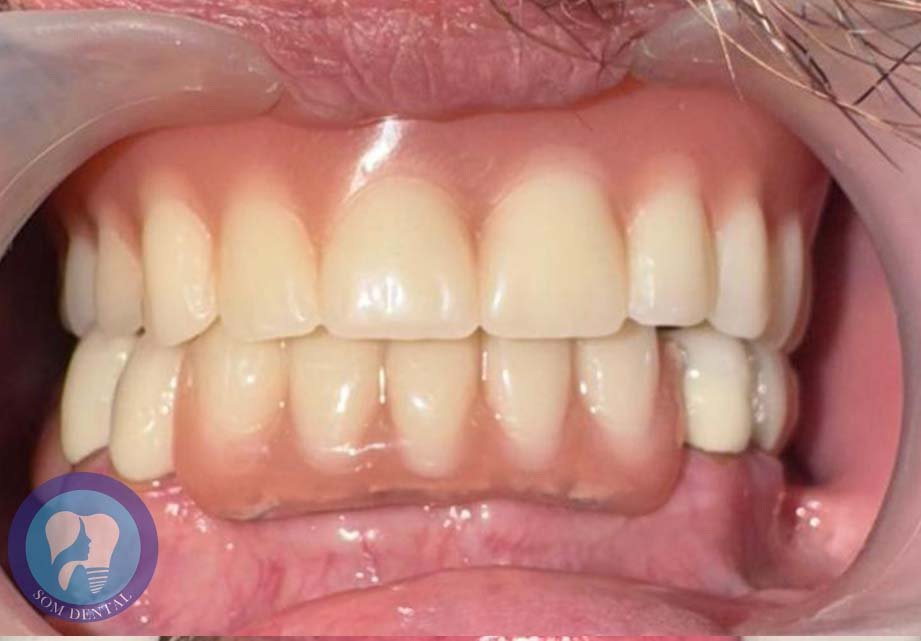 Cast Partial Dentures Gallery 6