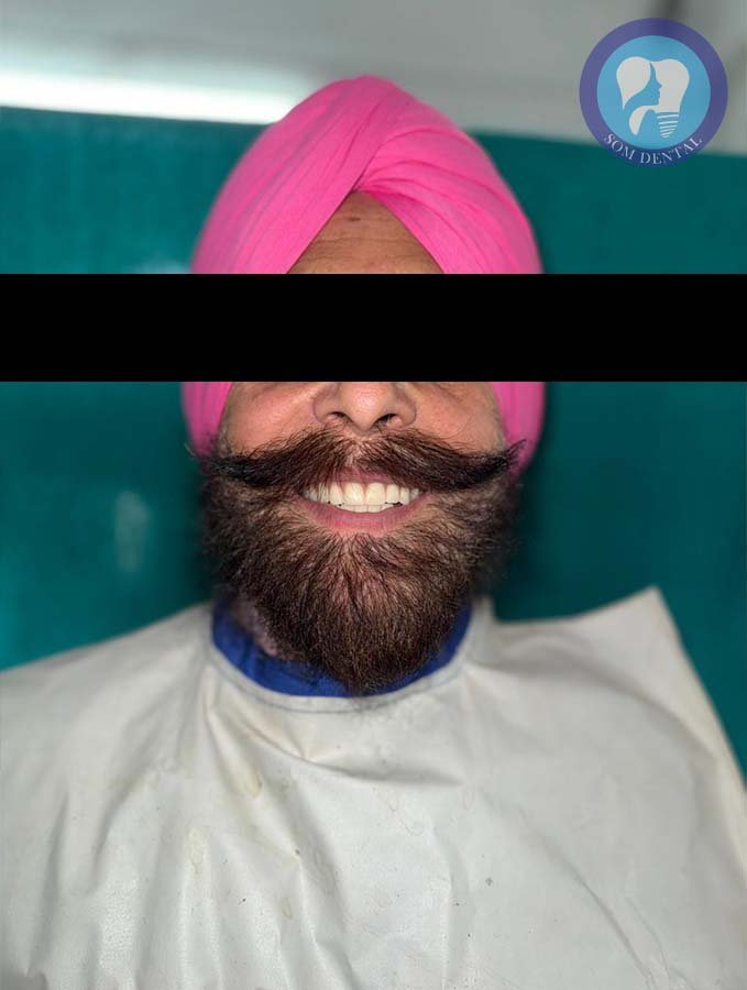 Cast Partial Dentures Gallery 8