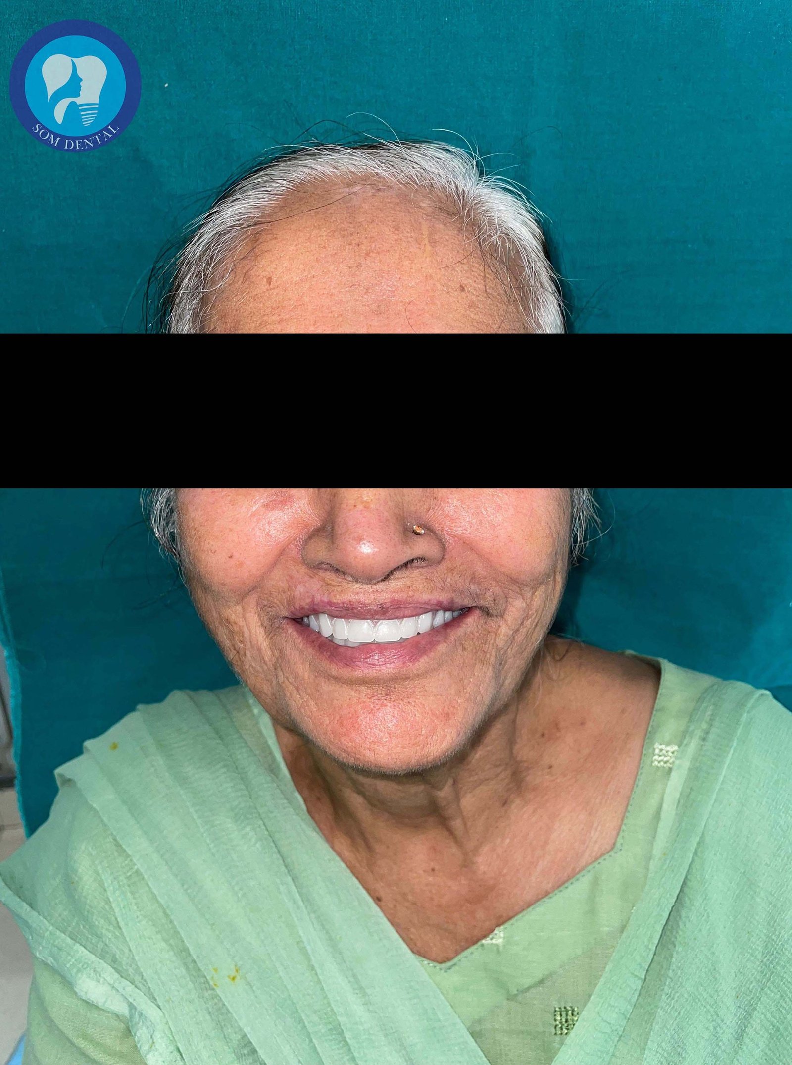 Complete Dentures Gallery 2