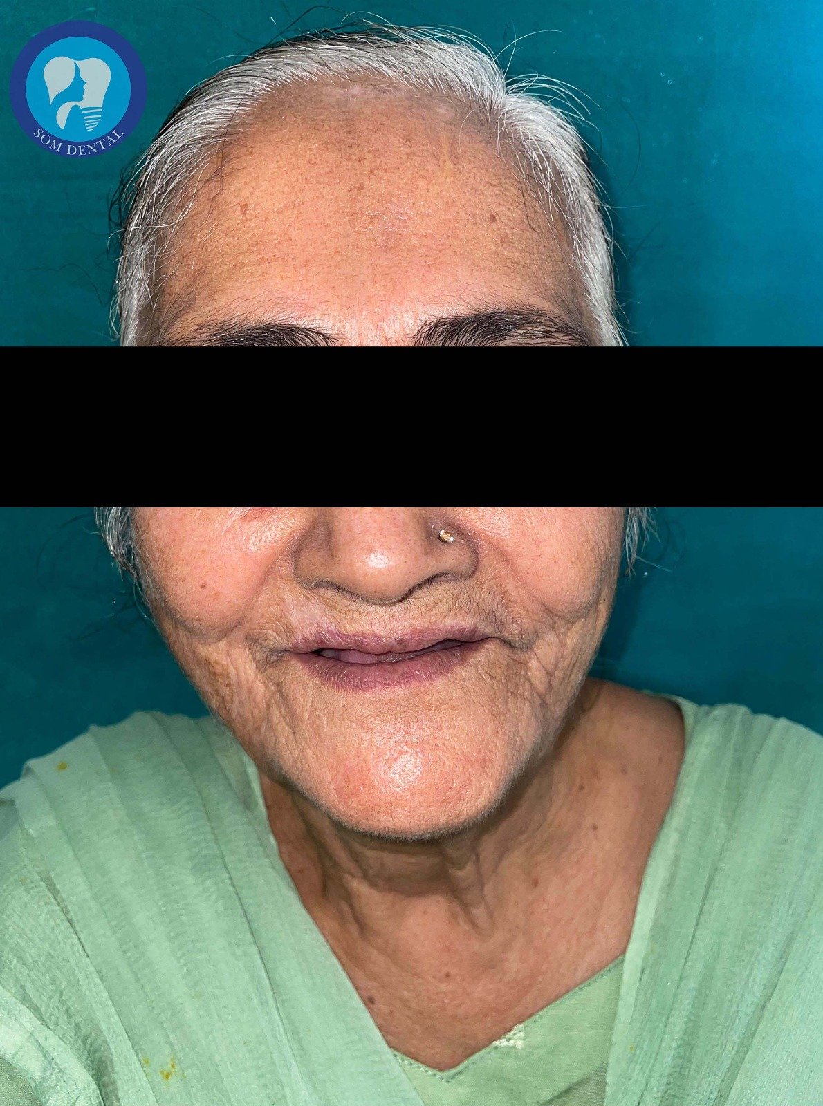 Complete Dentures Gallery 1