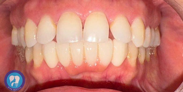 Laminates Veneers Gallery 1