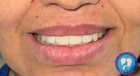 Laminates Veneers Gallery 2