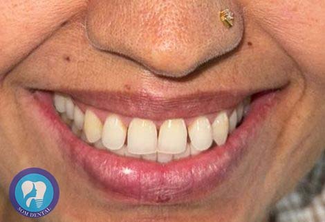 Laminates Veneers Gallery 3