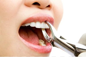 Tooth Extraction